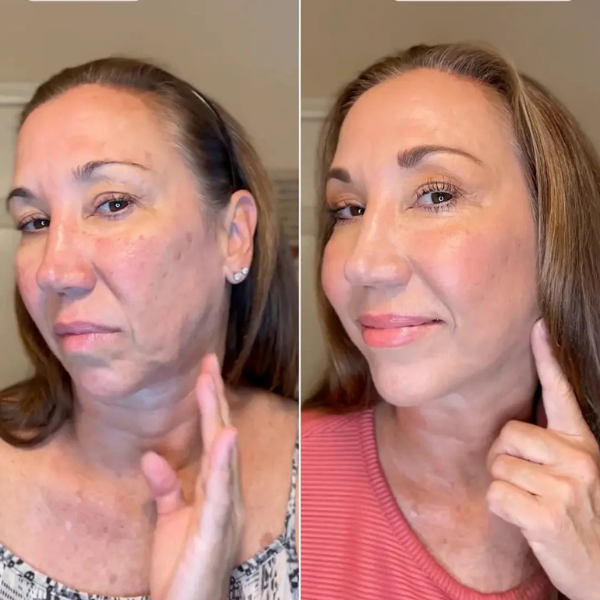 Aureva™ Dispositivo de Lifting Facial