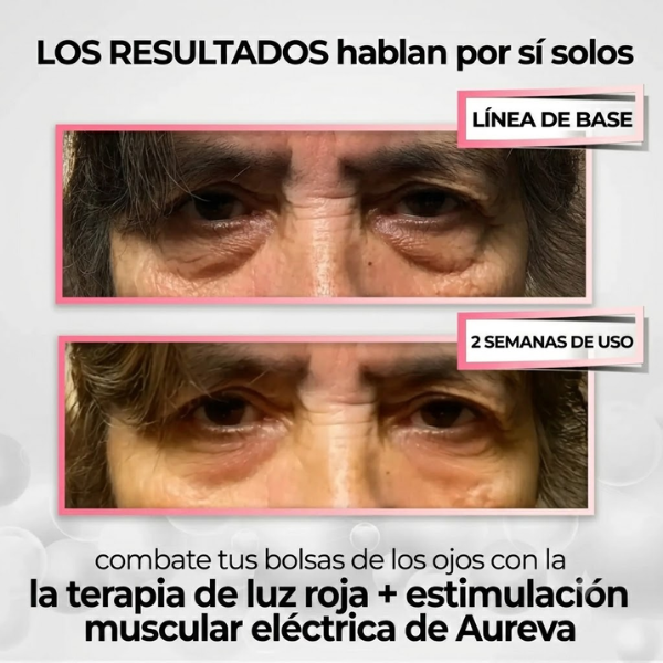 Aureva Eyelift