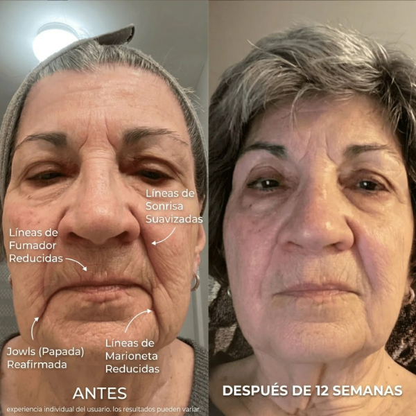 Sistema de Microinfusión