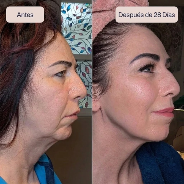Aureva™ Dispositivo de Lifting Facial