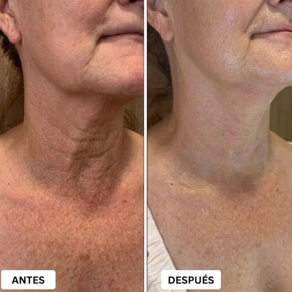Aureva™ Dispositivo de Lifting Facial